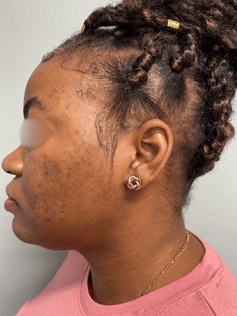 Acne and Dark Spots- Dark Skin Before