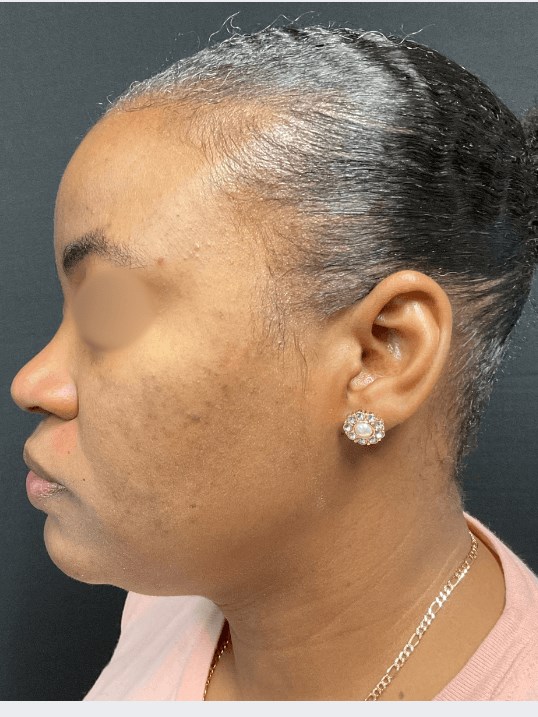 Acne and Dark Spots- Dark Skin After