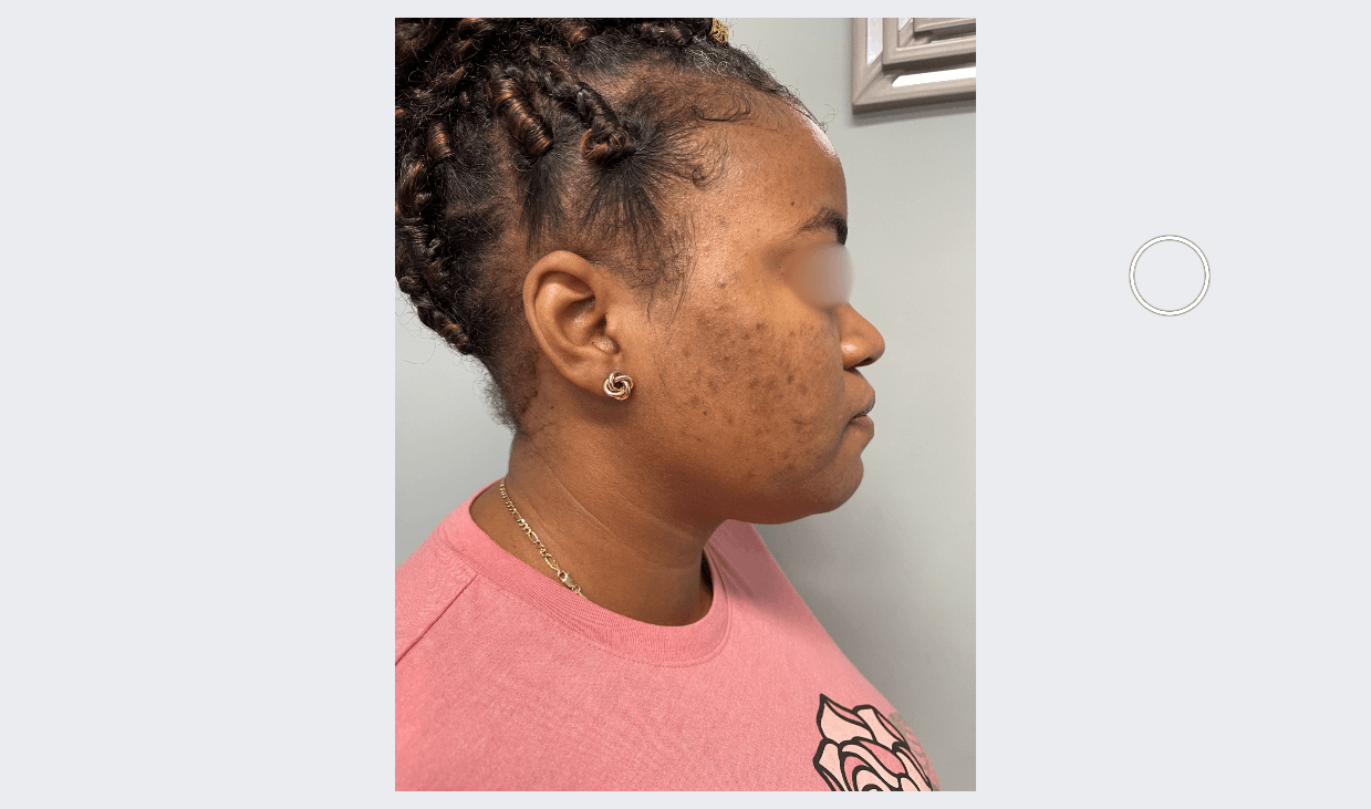 Acne and Dark Spots Next View Before