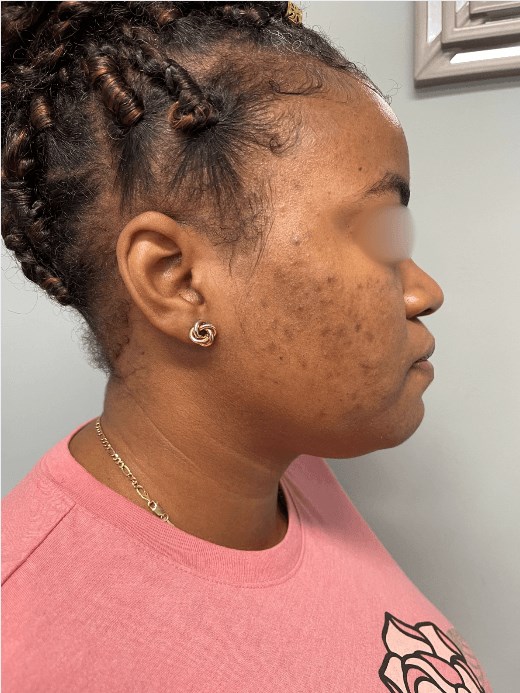 Acne and Dark Spots Next View Before