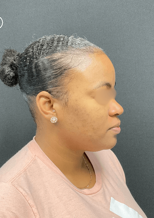 Acne and Dark Spots Next View After