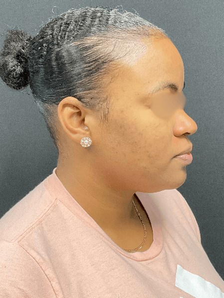 Acne and Dark Spots Next View After