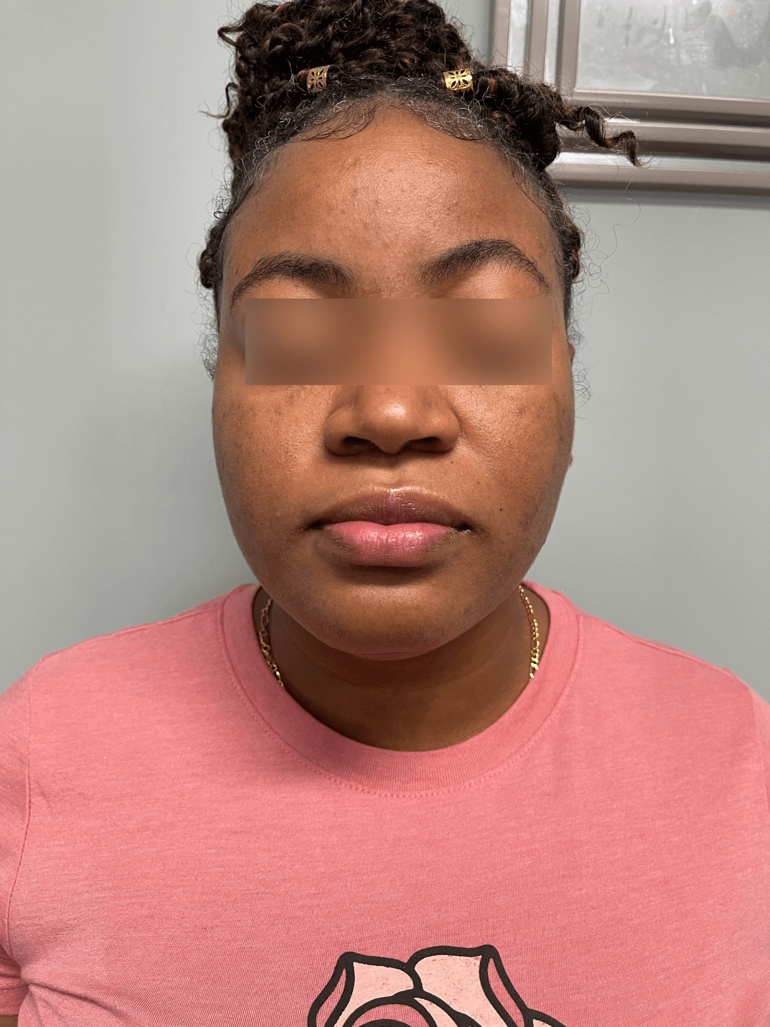 Acne and Dark Spots Front View Before