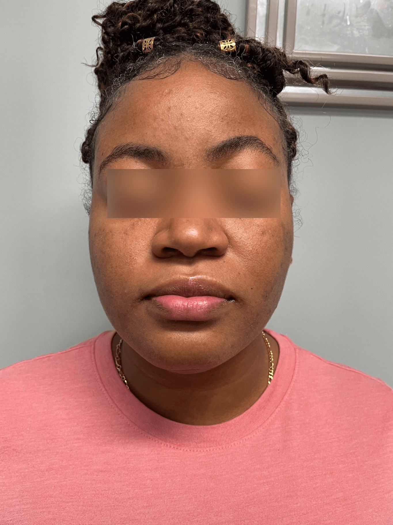 Acne and Dark Spots Front View Before