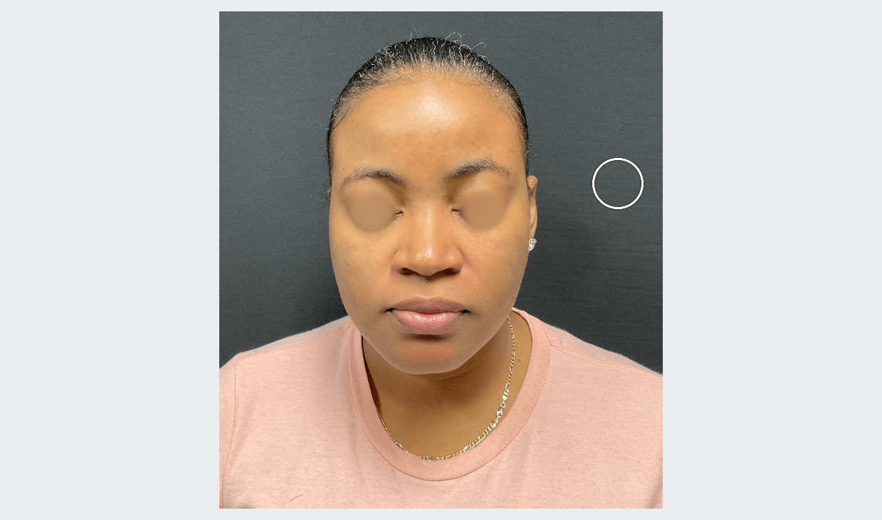 Acne and Dark Spots Front View After