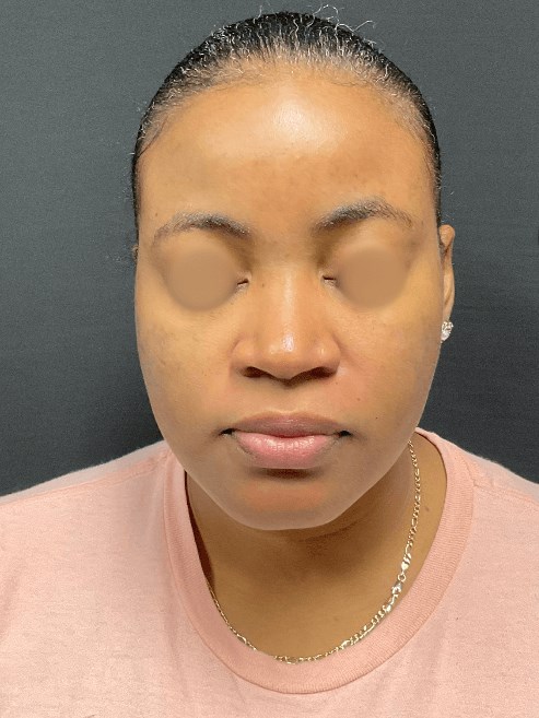 Acne and Dark Spots Front View After