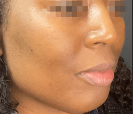 Beautiful Brown Skin - Side After