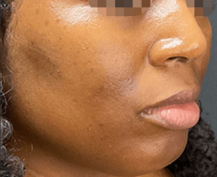 Beautiful Brown Skin - Side Before