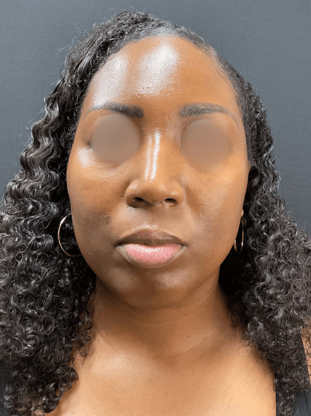 Beautiful Brown Skin - Front Before