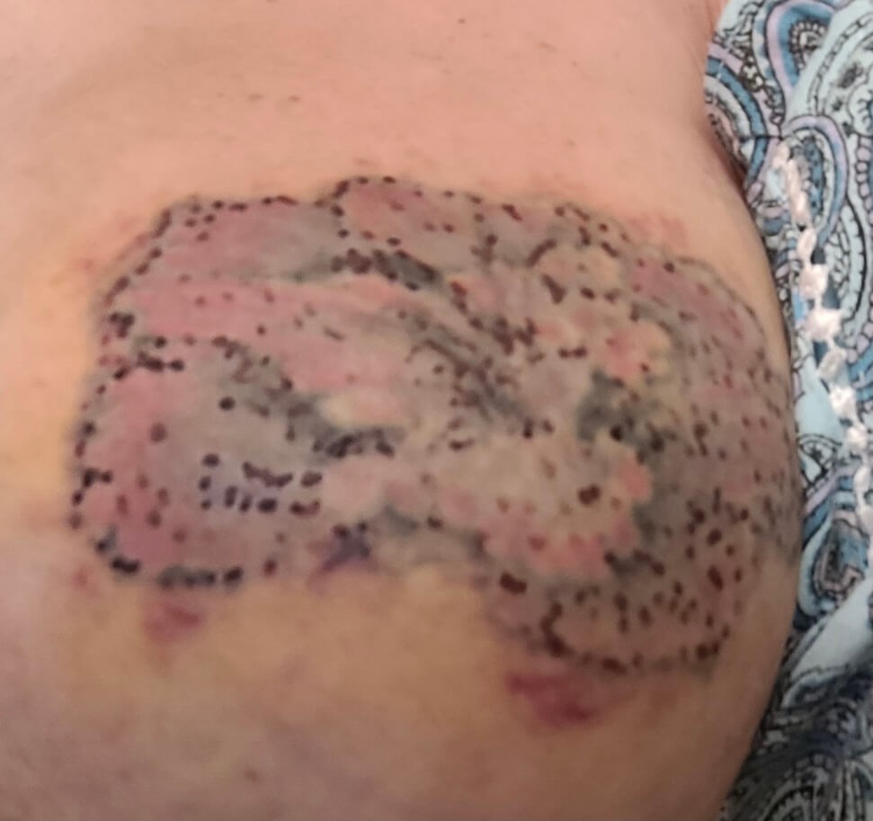 Tattoo Removal After