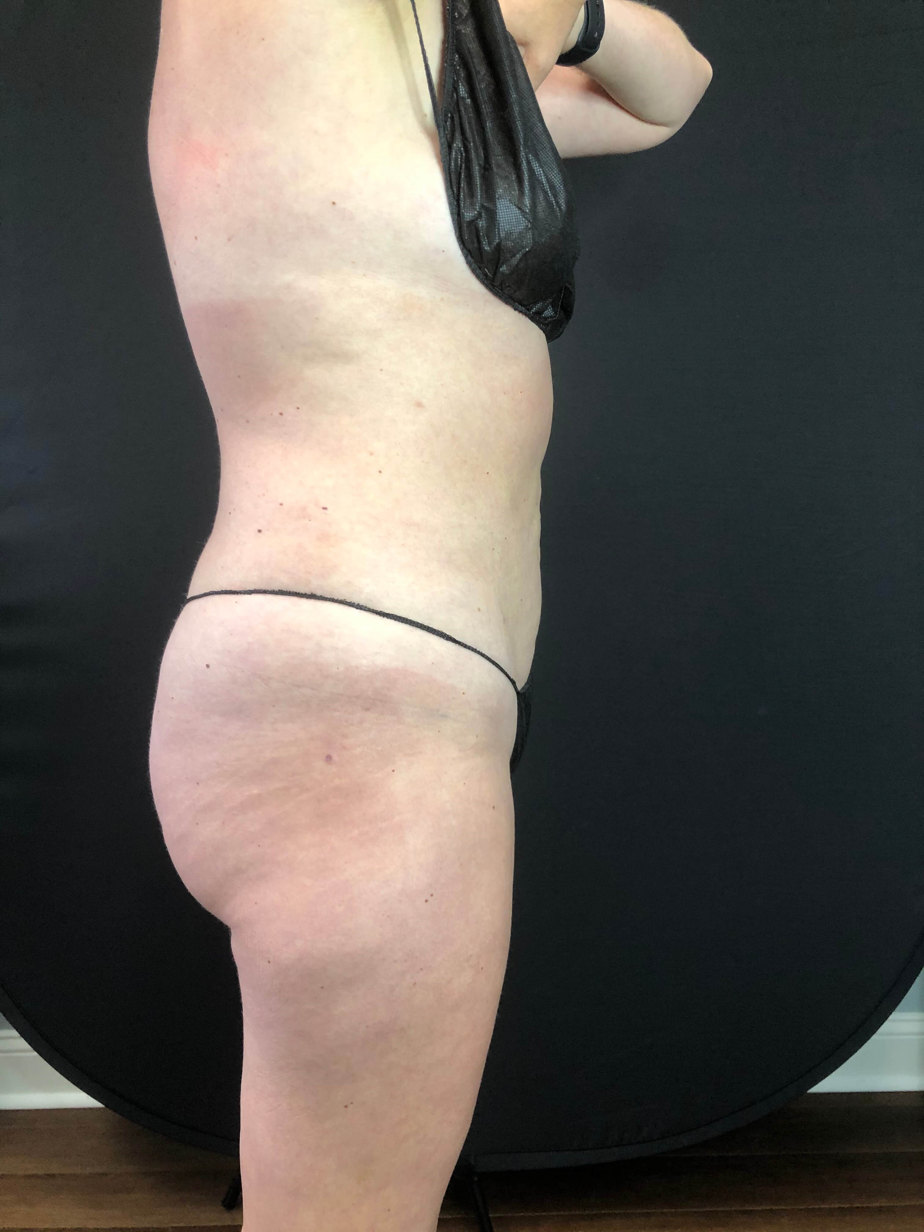 Mommy makeover After