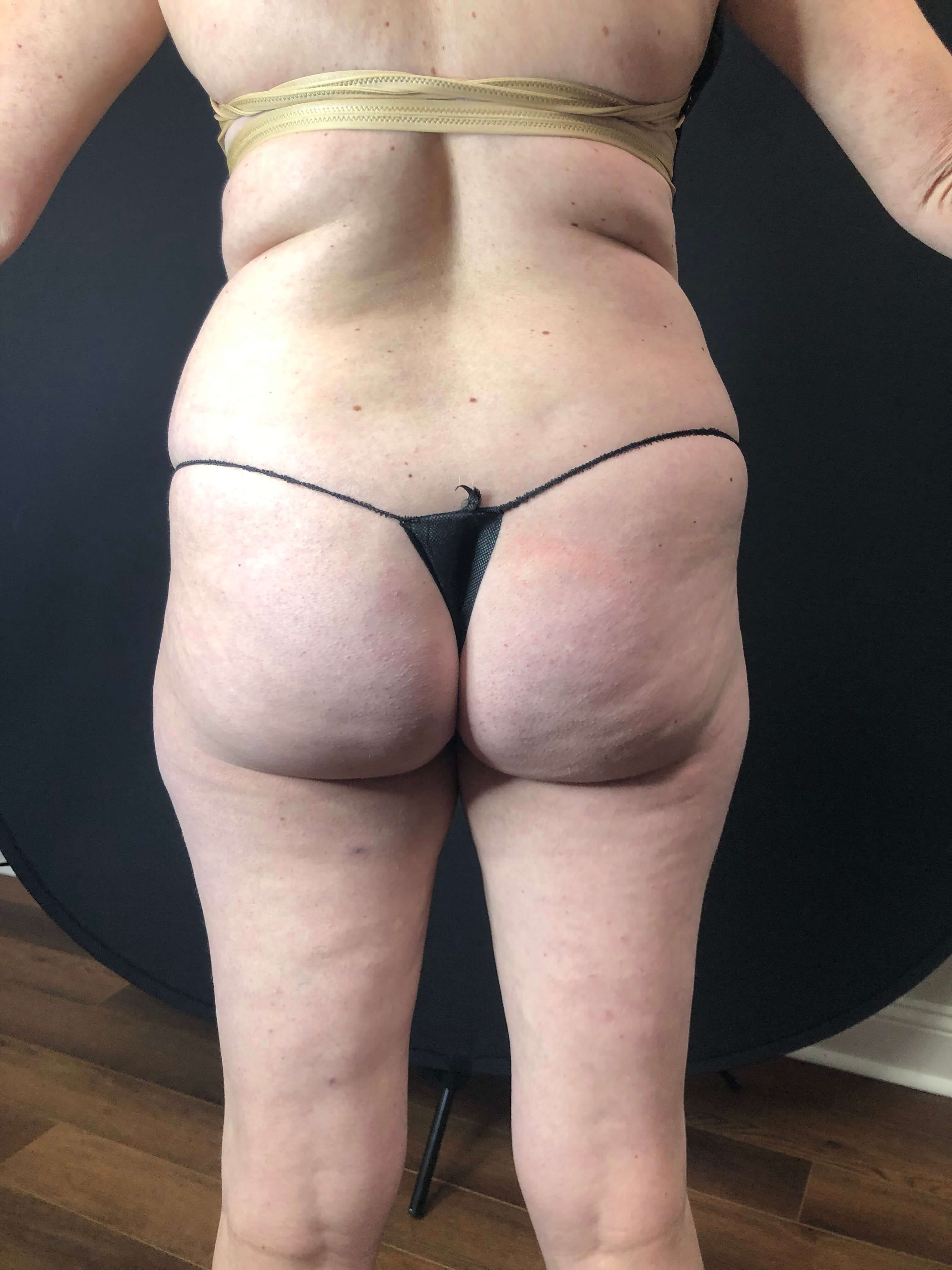 Mommy makeover Before