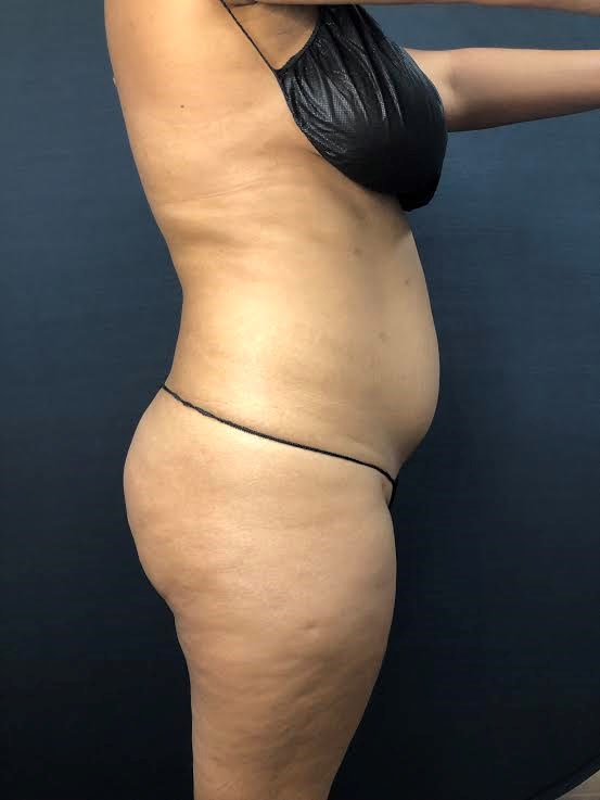 Brains & BOOTY with Beautifill Before