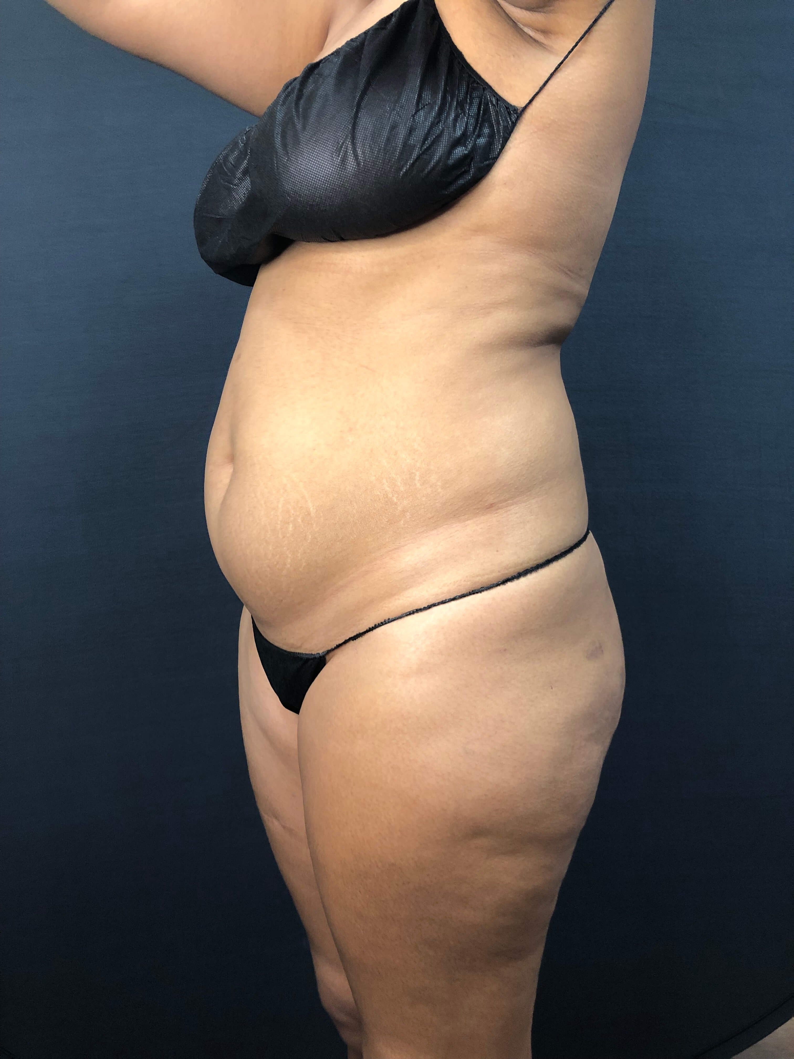 Brains & BOOTY with Beautifill Before