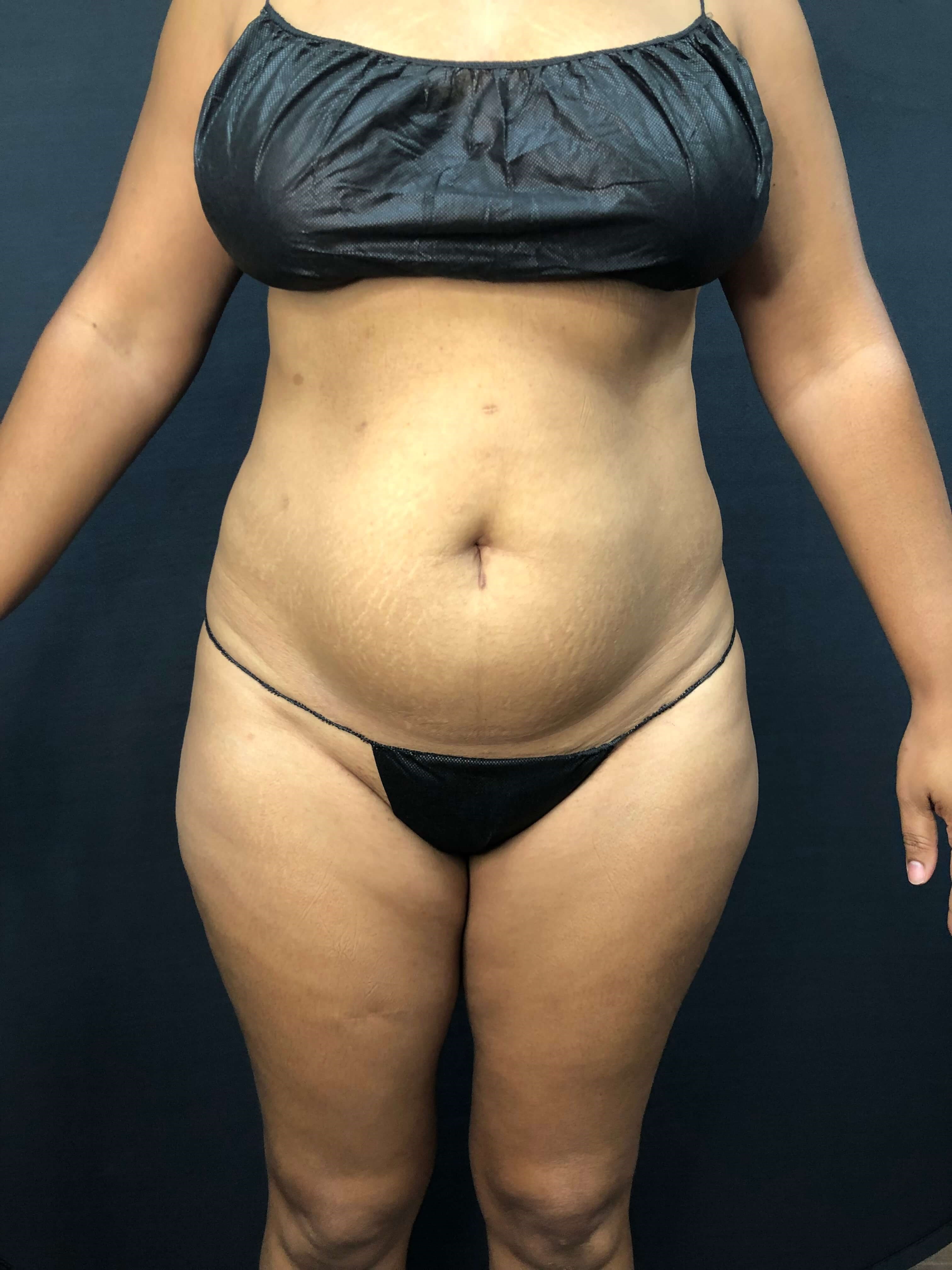 Brains & BOOTY with Beautifill Before