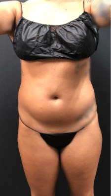 Coolsculpting Gone Wrong Before