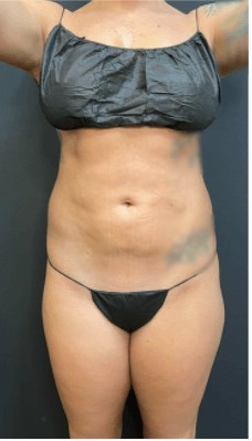 Coolsculpting Gone Wrong After