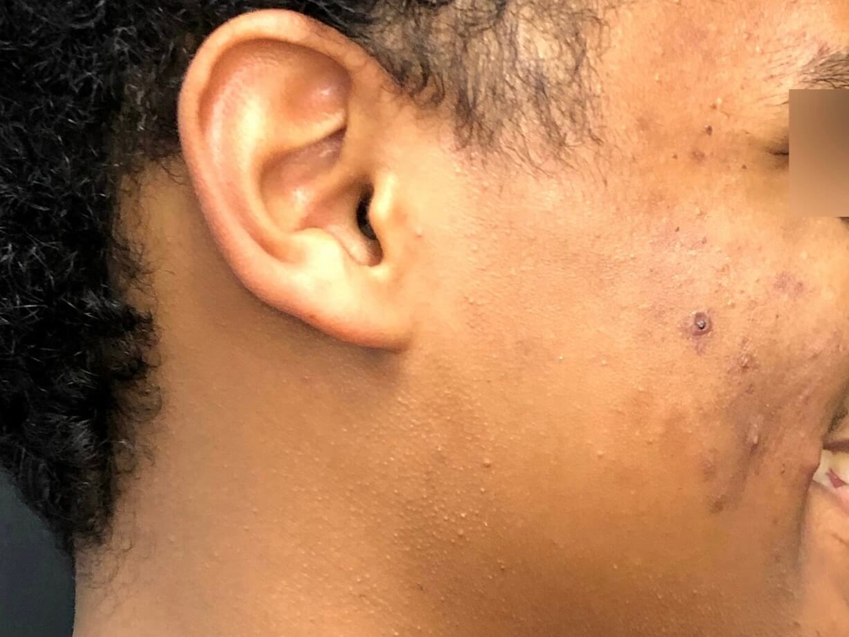 Acne scarring improved Before