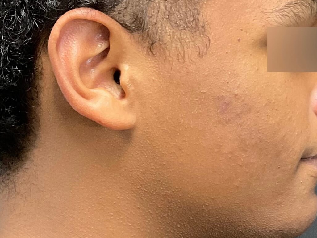 Acne scarring improved After