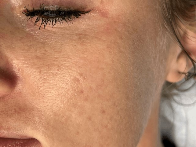 Acne scarring Before