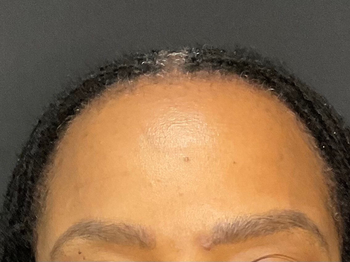 Never had Botox with lasers? After