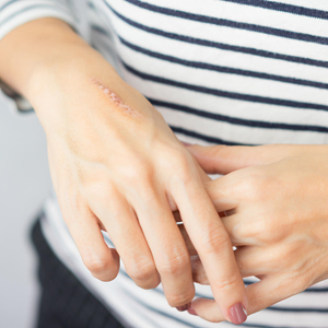 Scar Treatment Image