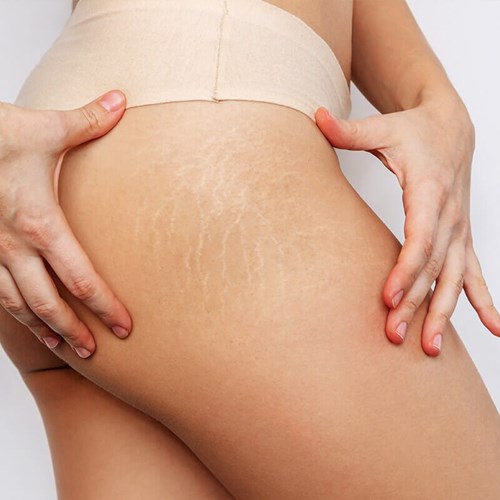 Stretch Mark Treatment