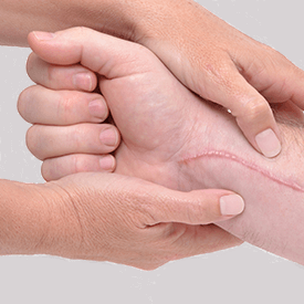 Laser Scar Treatment