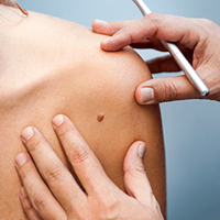 Laser Vein and Lesion Removal